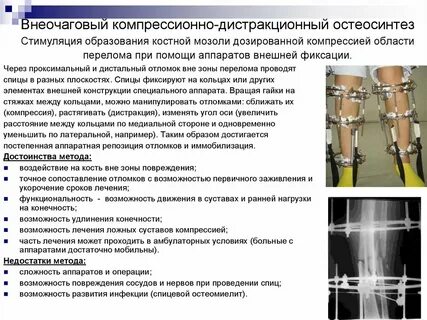 Лечение компрессии