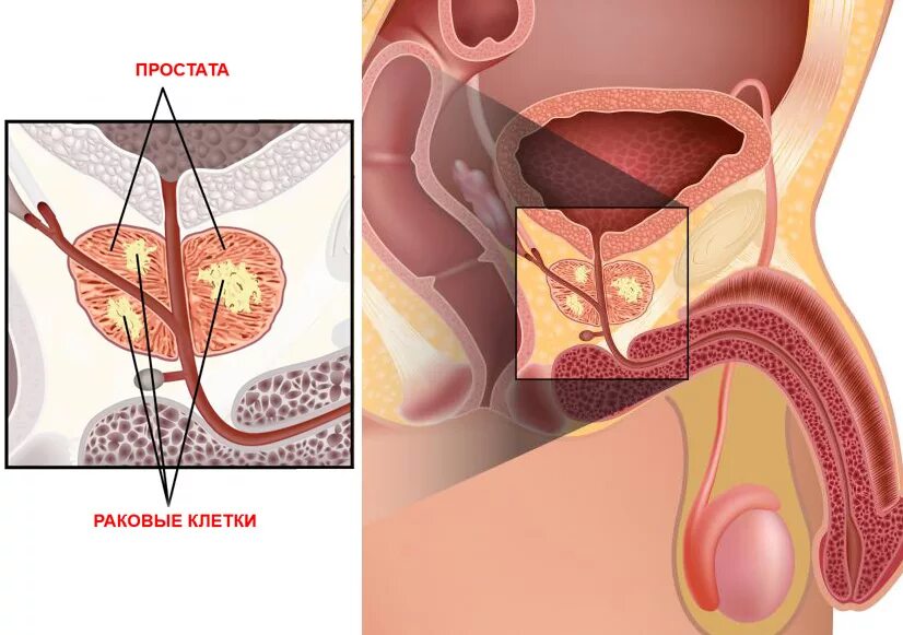 мочевой пузырь и простата схема. хронический простатит. аденома предстательной железы. хронический простатит. острый и хронический простатит.