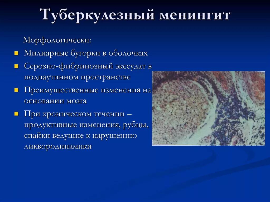 Мозговой туберкулез