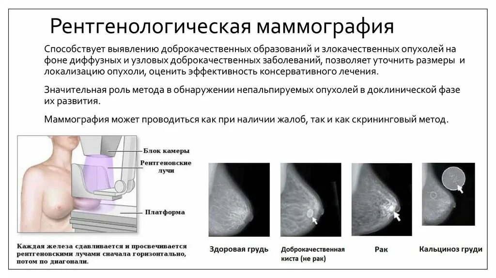 Рентгенологическая маммография. Мамаогра. Маммография метод исследования. Маммография периодичность