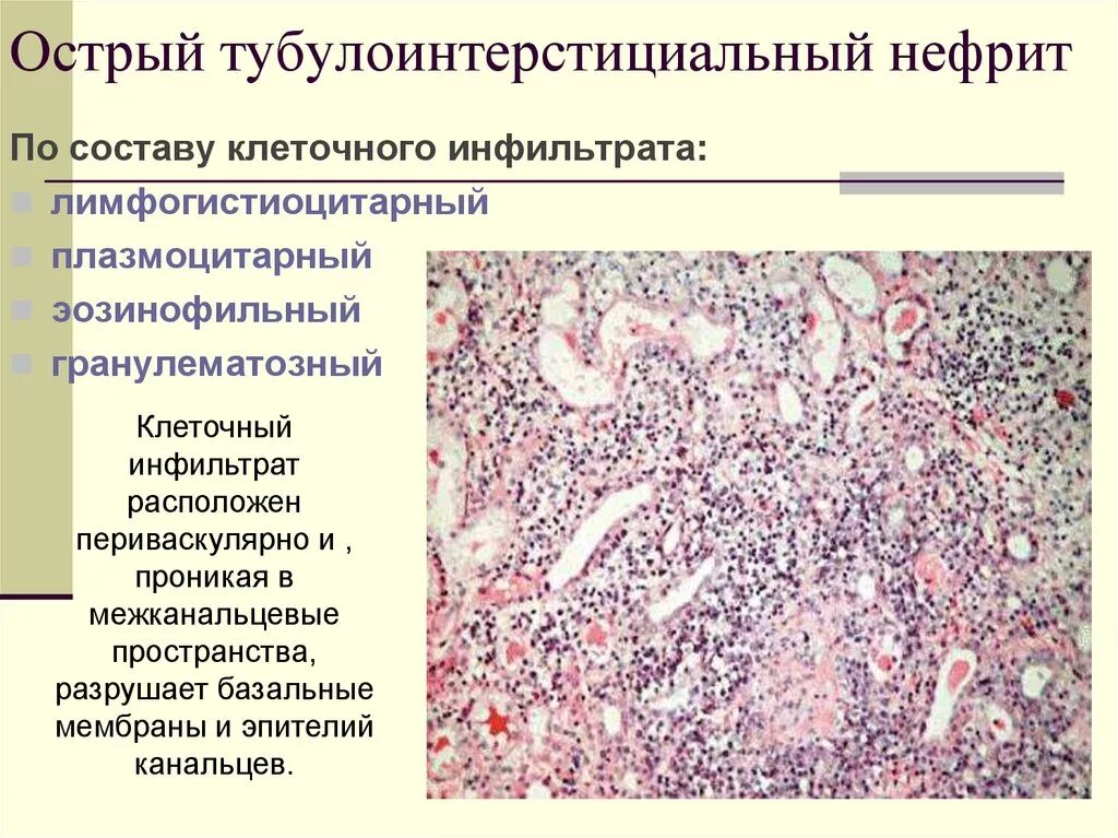 Интерстиций почки. Тубоинстециальный нефрит. Тубулоинтерстициальный нефрит патанатомия. Тубулоинтерстициальный нефрит патологическая анатомия. Хронический тубулоинтерстициальный нефрит гистология.