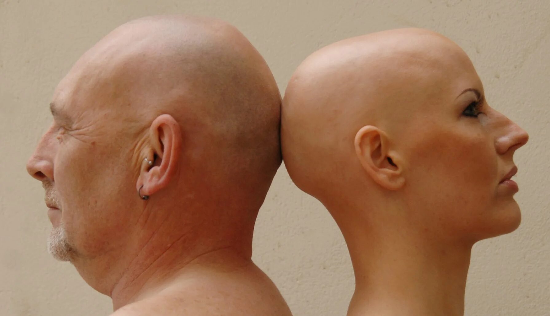 Химиотерапия облысение. Выпадение волос после химиотерапии. Химиотерапия облысение. Выпадение волос при химиотерапии. Химиотерапия облысение.