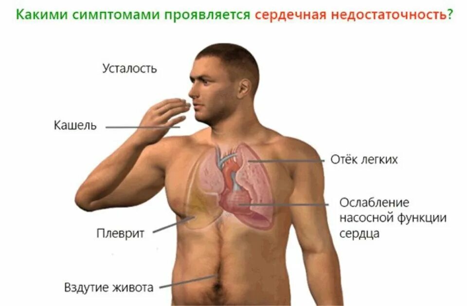 Кашель отек легких. Симптомы при сердечной недостаточности. Сердечная недостаточность симптомы. Сердечная недостаточность симпт. Признаки сердечной недо.