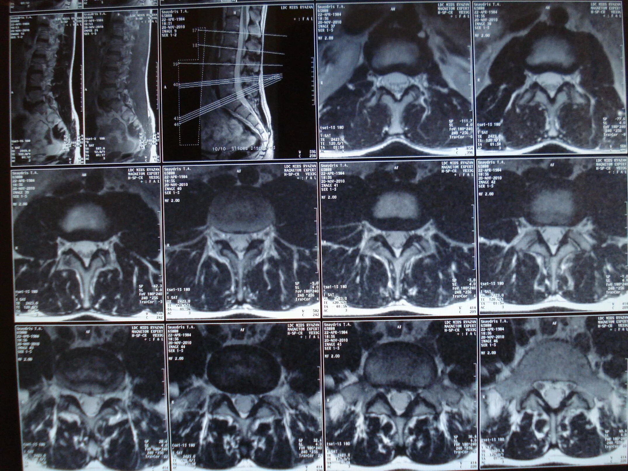 Мрт пояснично-крестцового отдела. Кт пояснично-крестцового отдела позвоночника. Мрт крестцового отдела позвоночника. Мрт поясничного отдела позвоночника.