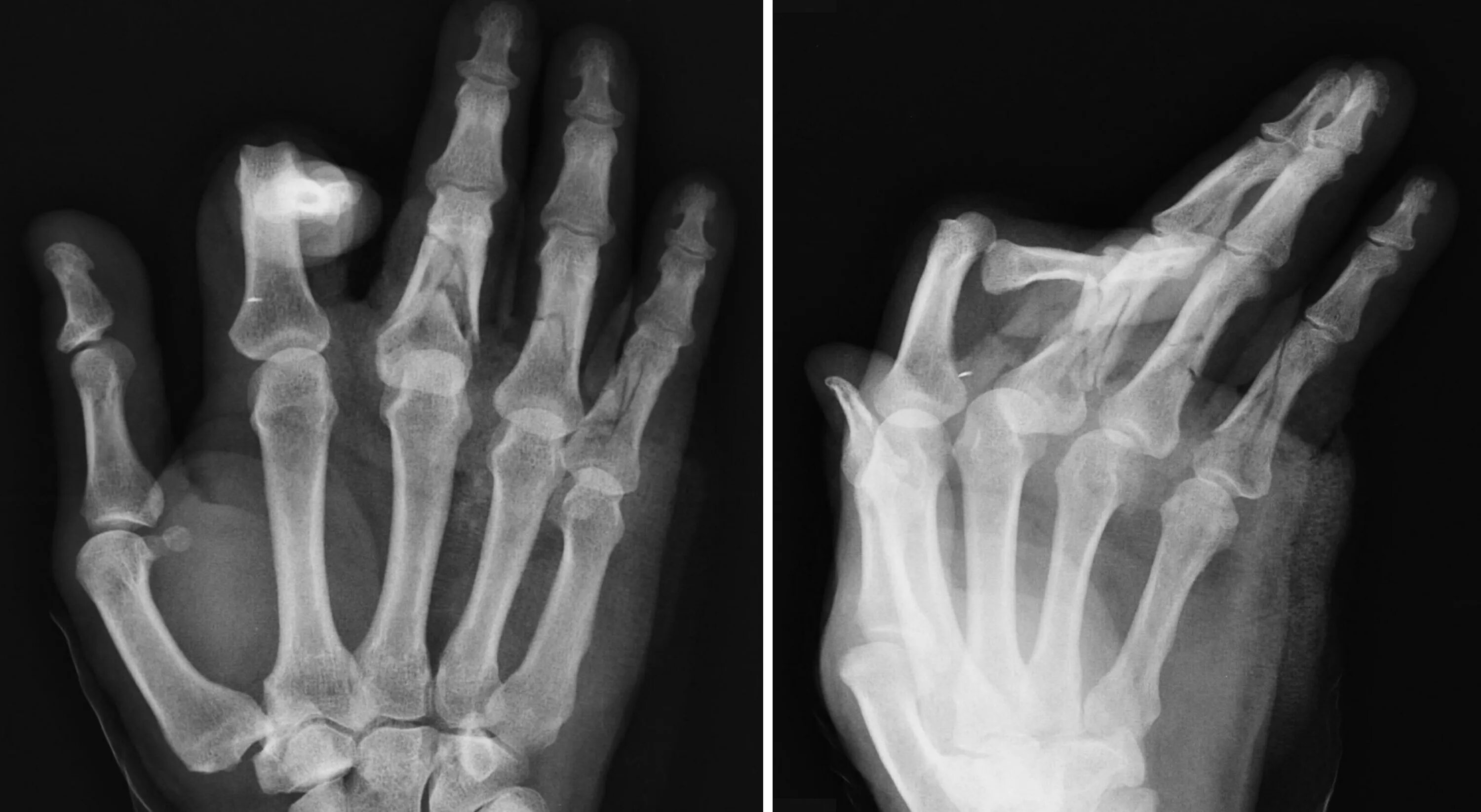 Трещина в кисти. Перелом фаланги мизинца рентген. Перелом фаланги большого пальца стопы рентген. Субкапитальный перелом 5 пястной кости. Подвывих фаланги пальца руки рентген.