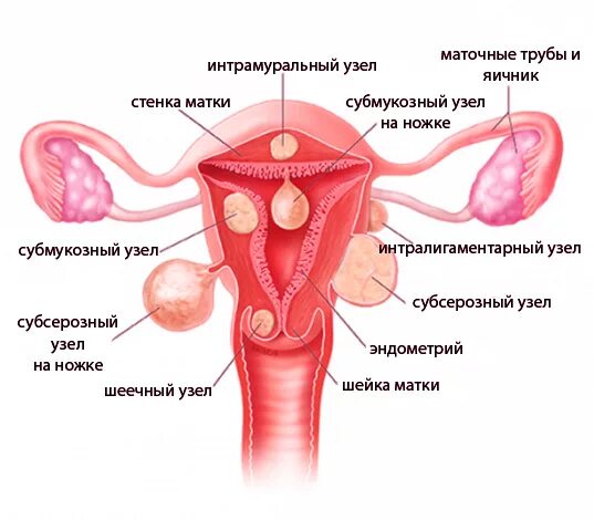 Лейомиома матки что это. Интрамуральная миома матки что это такое. Интрамурально субмукозная миома матки. Миома матки классификация по локализации.