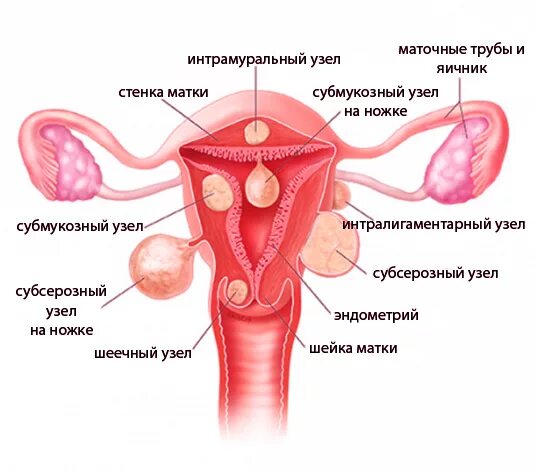 Интрамурально субмукозная миома матки. Миома матки классификация по локализации. Миома матки локализация узлов. Интрамуральная миома матки схема. Миома на задней стенке матки