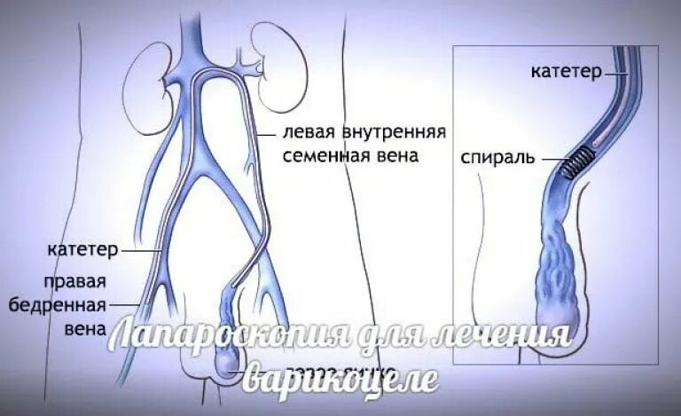 Расширение семенной вены. Операция Иваниссевича и Мармара. Расширение вен семенного канатика. Операция при варикоцеле.