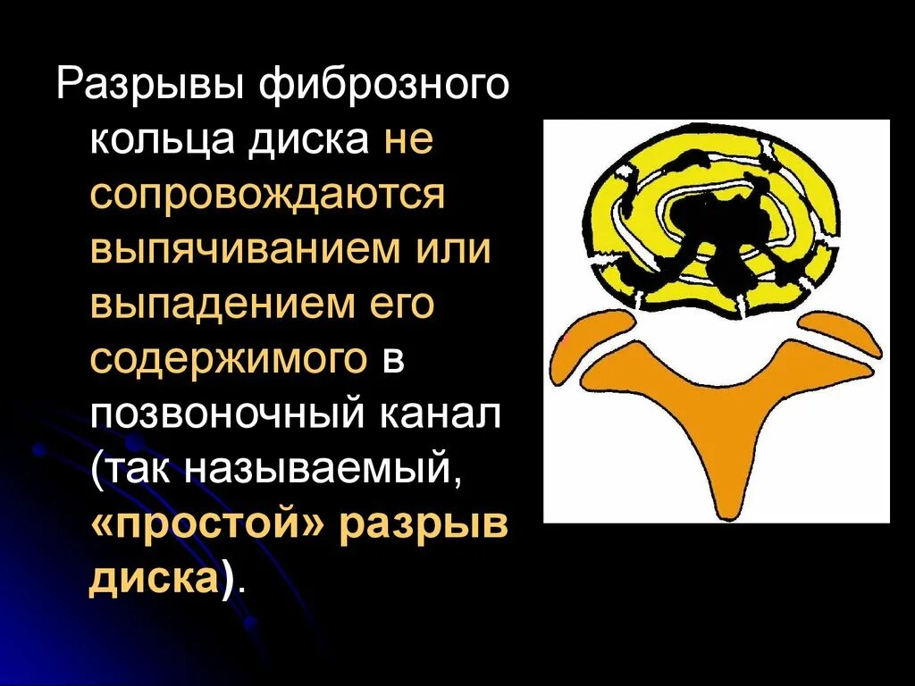 Разрыв диска. Разрыв фиброзного кольца. Разрыв фиброзного кольца диска. Надрыв фиброзного кольца. Грыжа позвоночника разрыв фиброзного кольца.