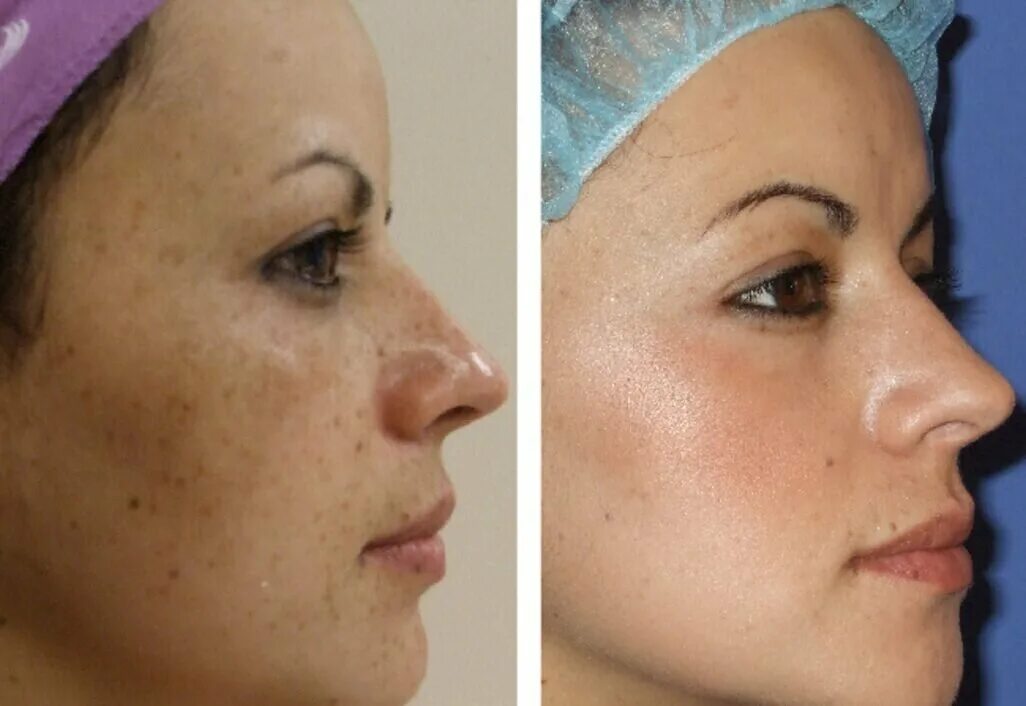 Тса пилинг лицо. Срединные пилинги (тса 10-20%). Глубокий феноловый пилинг. Пилинг джесснера эффект. Тса 20 пилинг.