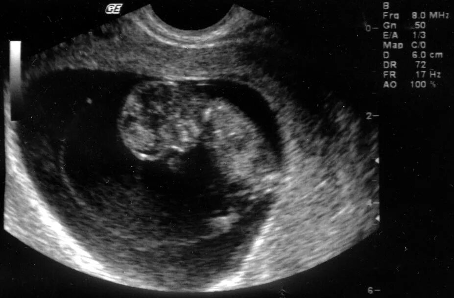 10 Недель беременности фото плода на УЗИ. УЗИ на 10 акушерской неделе беременности. Снимок УЗИ на 10 неделе беременности. УЗИ плода на 10 неделе беременности.