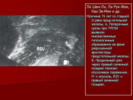 Предстательная железа в норме узи