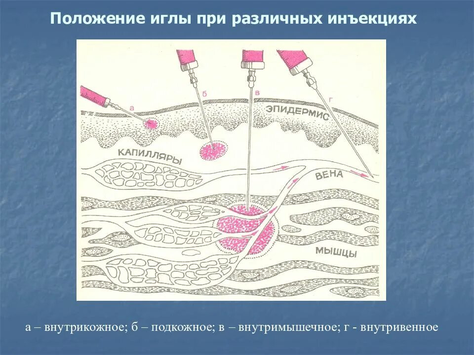 Внутрикожная глубина введения иглы. Положение иглы при различных инъекциях. Глубина введения при внутрикожной инъекции. Угол введения иглы при внутрикожной. Угол пр внутри кожаном введениииглы.