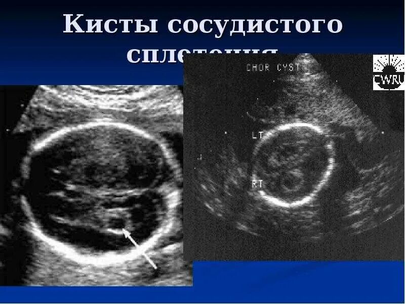 Ультразвуковая анатомия головного мозга новорожденного. Кисты сосудистых сплетений головного мозга у плода. Киста сосудистого сплетения. Киста сосудистого сплетения на узи. Сосудистое сплетение у новорожденного.