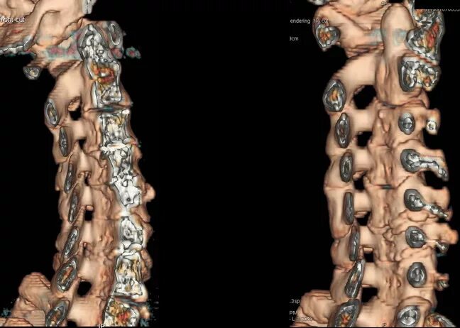 Кт позвоночника. Грыжа позвоночника на кт. Грыжа позвоночника МСКТ. Грыжа в шейном отделе позвоночника кт. Можно делать кт позвоночника