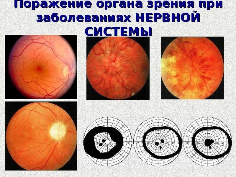 Изменения на глазном дне. Изменения глазного дна при заболеваниях. Поражение органов зрения.