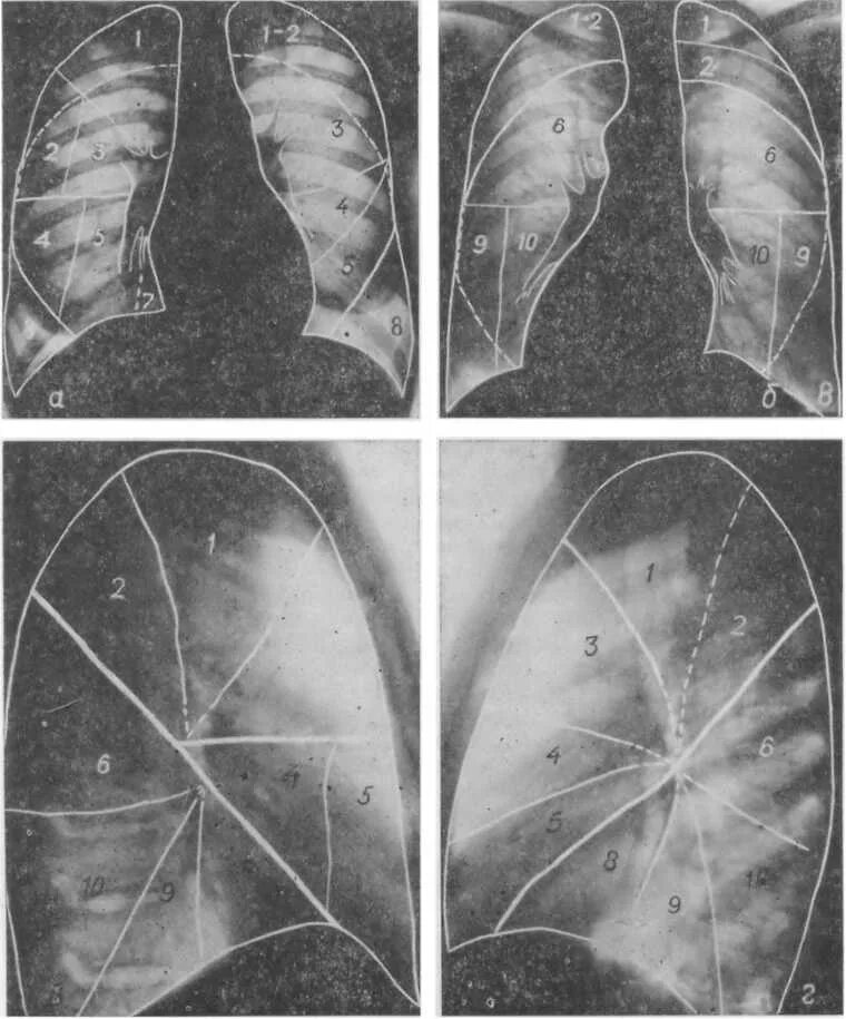 Доли легкого на рентгенограмме. Сегментарное строение легких рентген. S2 сегмент левого легкого. Сегменты легкого s1 s2. 9 Сегмент правого легкого.