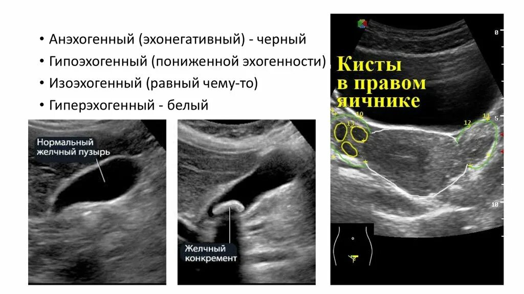 Образование округлое в яичнике. Анэхогенная структура УЗИ. Гипоэхогенное образование УЗИ. Эхогенная структура что это.