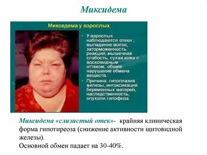 Микседема при гипотиреозе