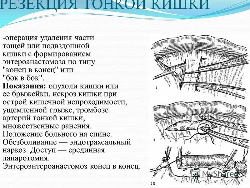 Принципы резекции тонкой кишки. Этапы операции резекции тонкой кишки. Резекция тонкой кишки этапы. Опули подвдошной ктшки. Операции через прямую кишку