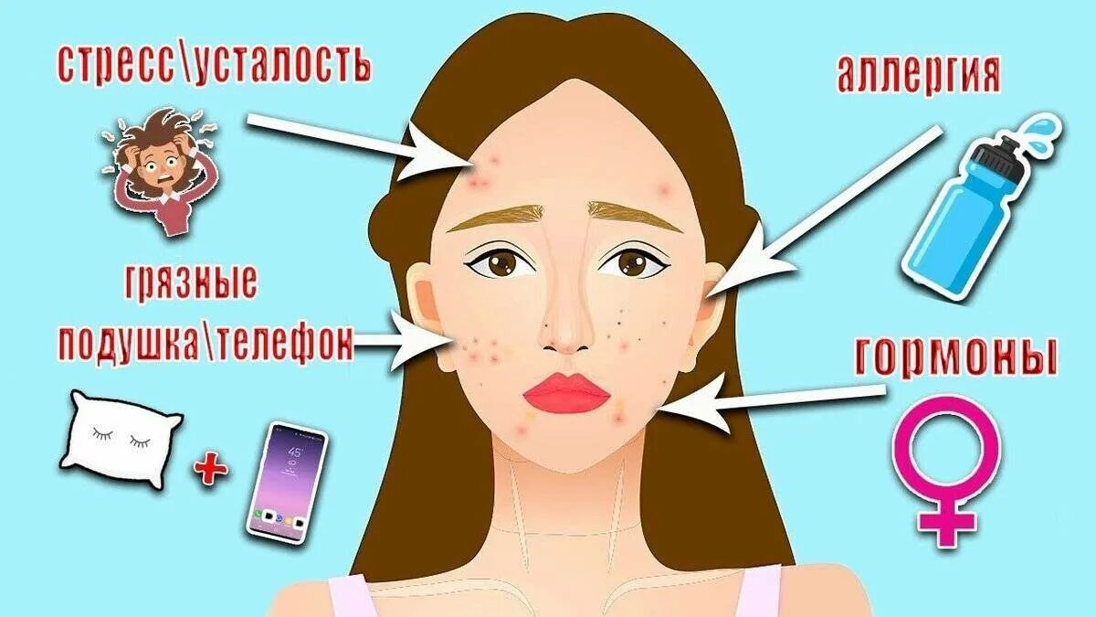 Как сделать прыщи из бумаги. Причины возникновения прыщей. гормональные прыщи на подбородке. типы подростковых прыщей. акне на лице причины по зонам.