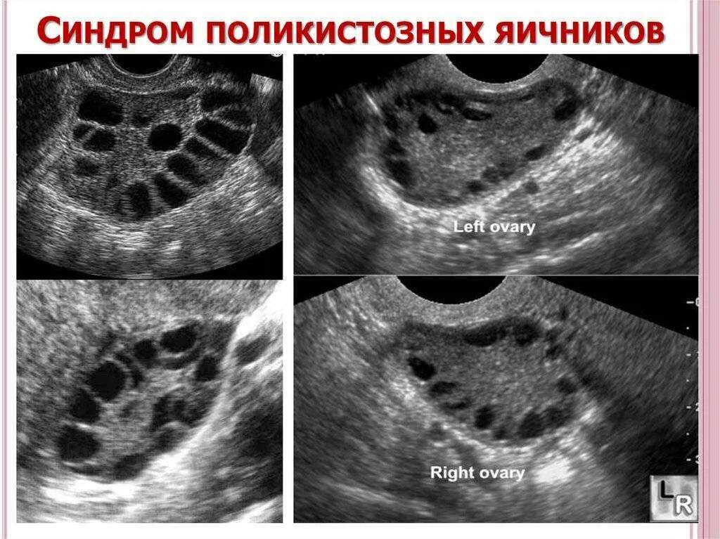 Синдром поликистоза яичников на УЗИ. Фолликулярный поликистоз яичников. Снимок УЗИ поликистоз яичников. Мультифолликулярные поликистоз яичников.