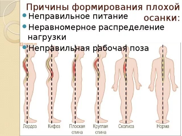 Причины плохой осанки. Причины формирования неправильной осанки. Процесс формирования осанки. Неравномерное распределение нагрузки на позвоночник. Женщина с нарушением в развитии скелета