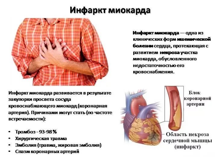 Боли в области сердца у мужчины. Симптомы ИБС инфаркт миокарда. Сердечно сосудистая система при инфаркте миокарда. Форма сердца при инфаркте миокарда. Болит сердце.