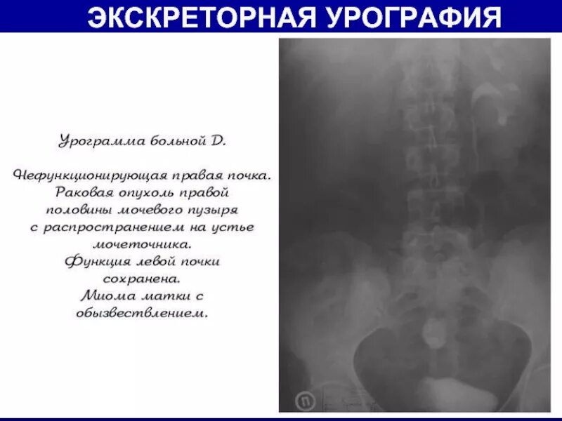 После урографии