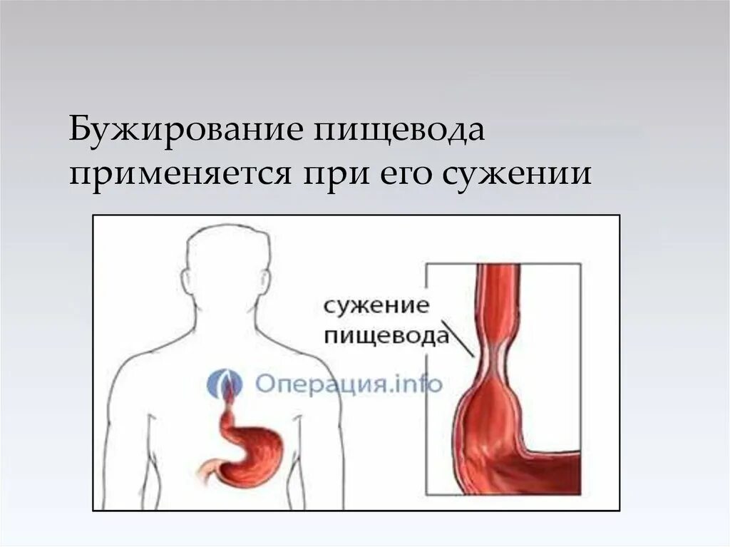 Антеградное бужирование пищевода. Методика бужирования пищевода. Бужирование пищевода этапы операции. Бужирование стриктуры пищевода.