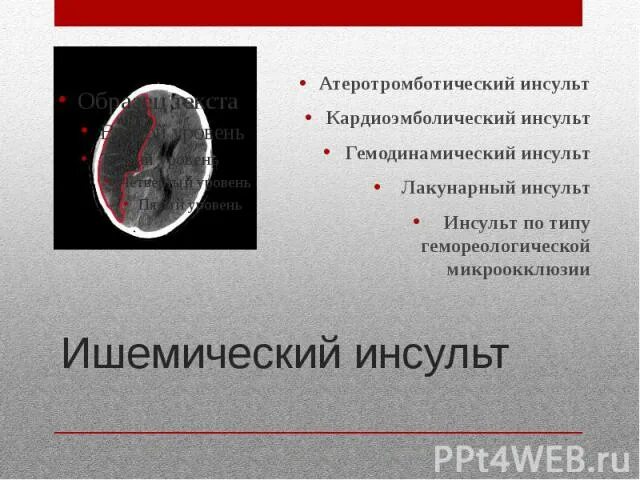 Перенесенный инсульт мкб. Мкб ишемический инсульт кардиоэмболический. Ишемический инсульт код мкб 10. Код мкб лакунарный ишемический инсульт. Ишемический кардиоэмболический инсульт мкб 10.