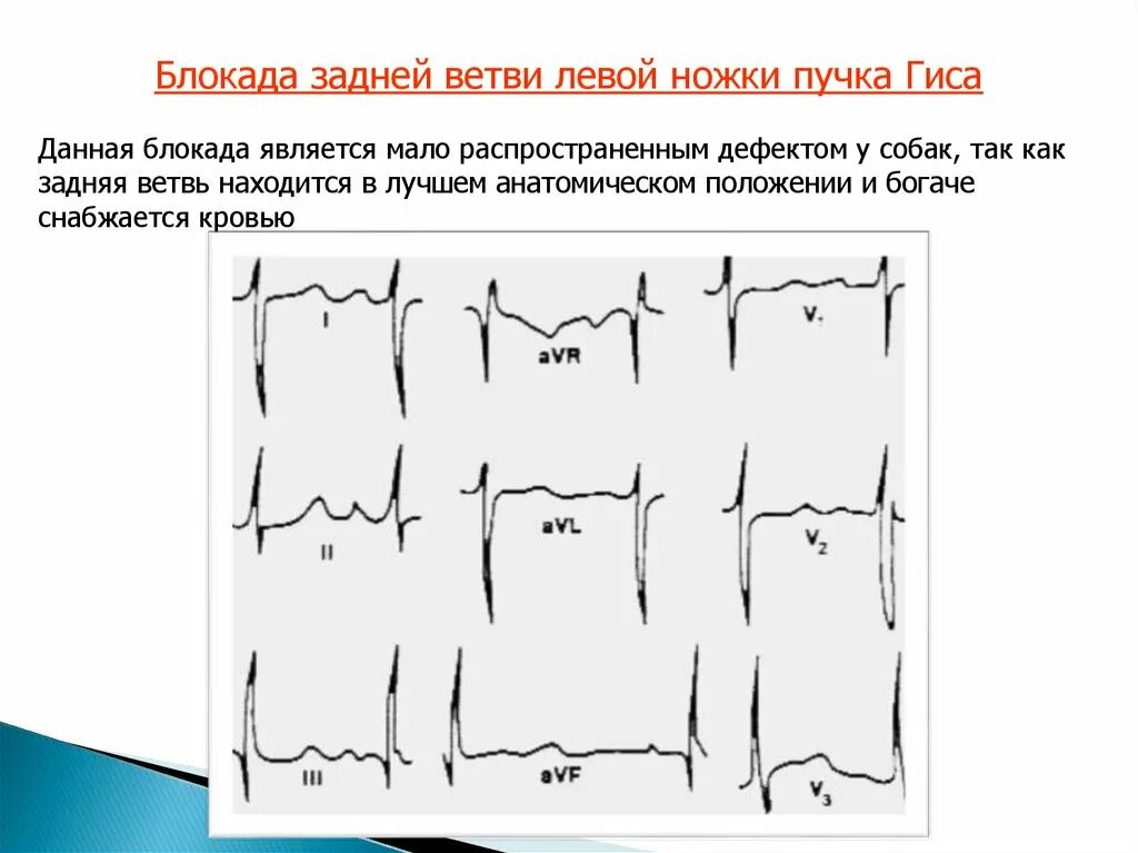 Блокада задней ножки. Отклонение ЭОС вправо, блокада задней ветви левой ножки пучка Гиса;. Блокада задней ветви левой ножки на ЭКГ. Блокада ветвей левой ножки пучка Гиса на ЭКГ. Неполная блокада передней ветви ЛНПГ на ЭКГ.