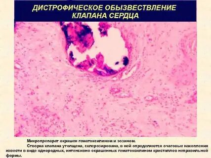 Кальциноз стенок