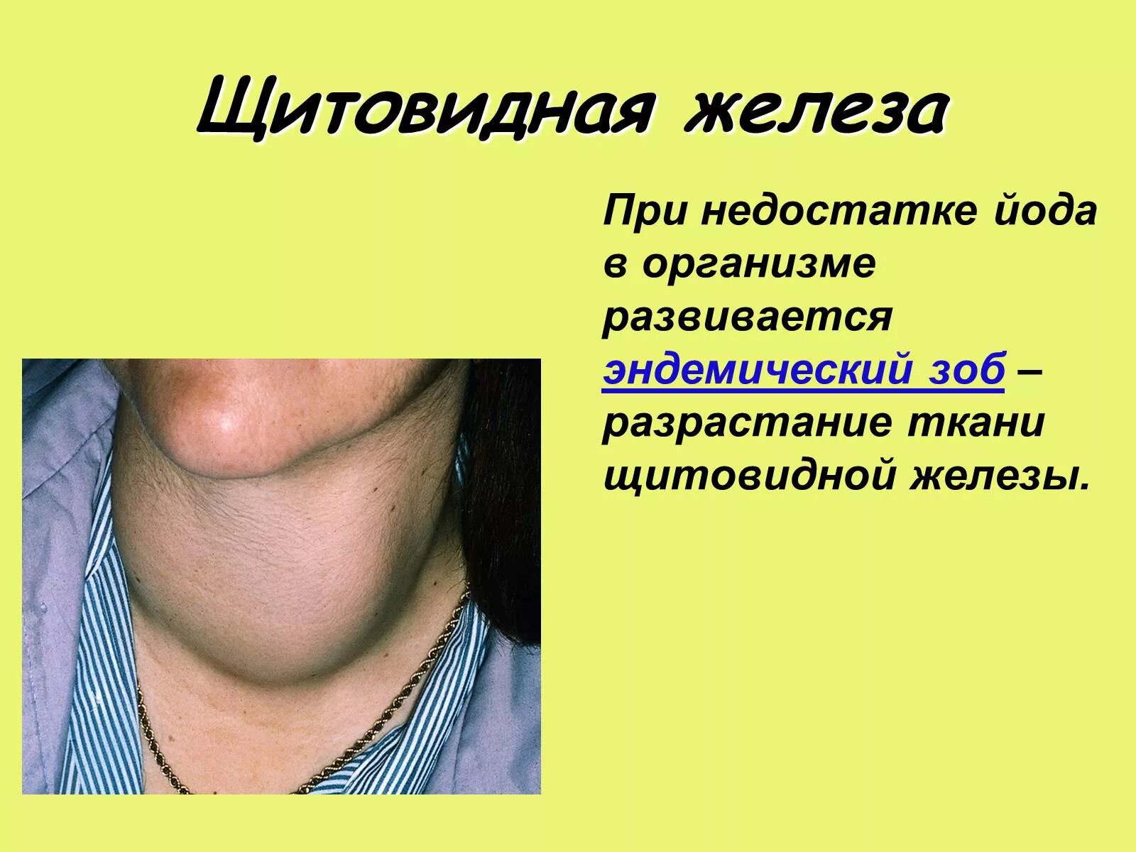 Что значит зоб. Щитовидная щитовидная железа. При недостатке щитовидной железы.