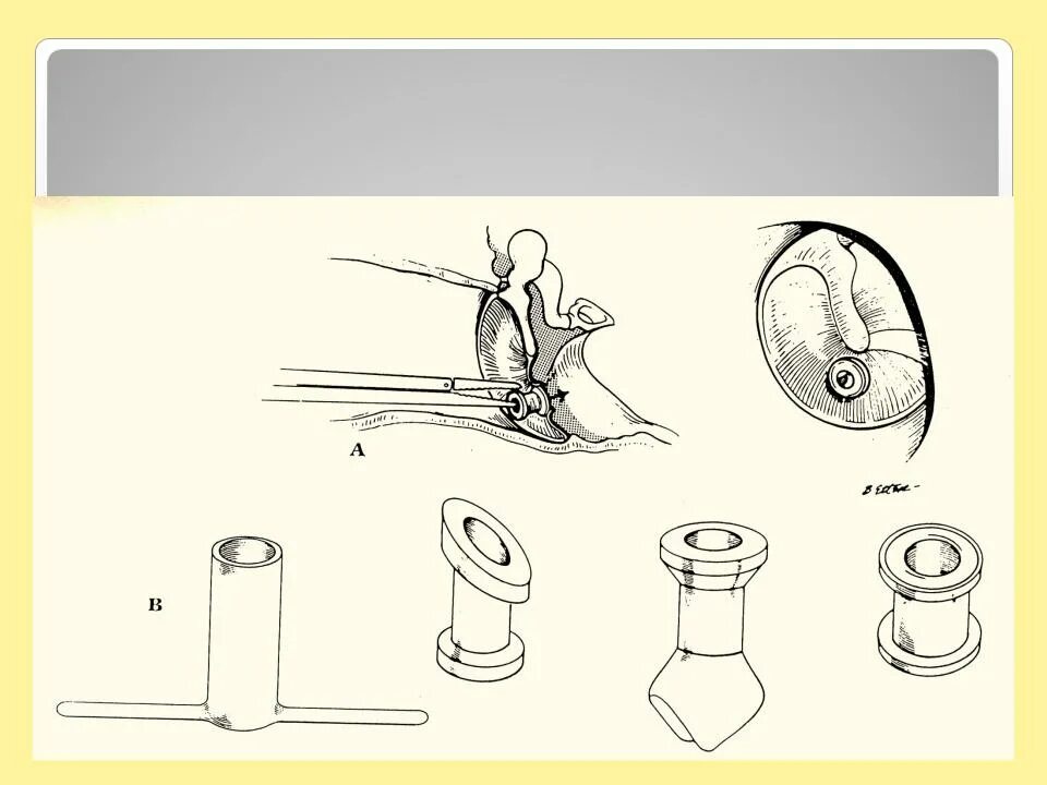 Коронарное стентирование сосудов сердца. Шунт барабанной перепонки. Аорта каронарное шунтирование это. Транслюминальная баллонная ангиопластика. Шунт барабанной перепонки.