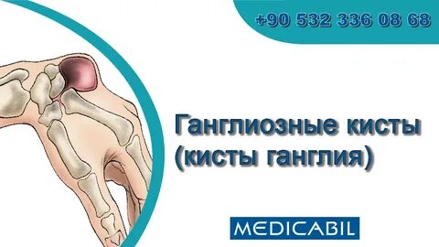 Киста картинка
