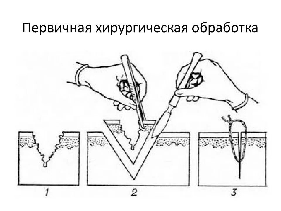Пхо в хирургии