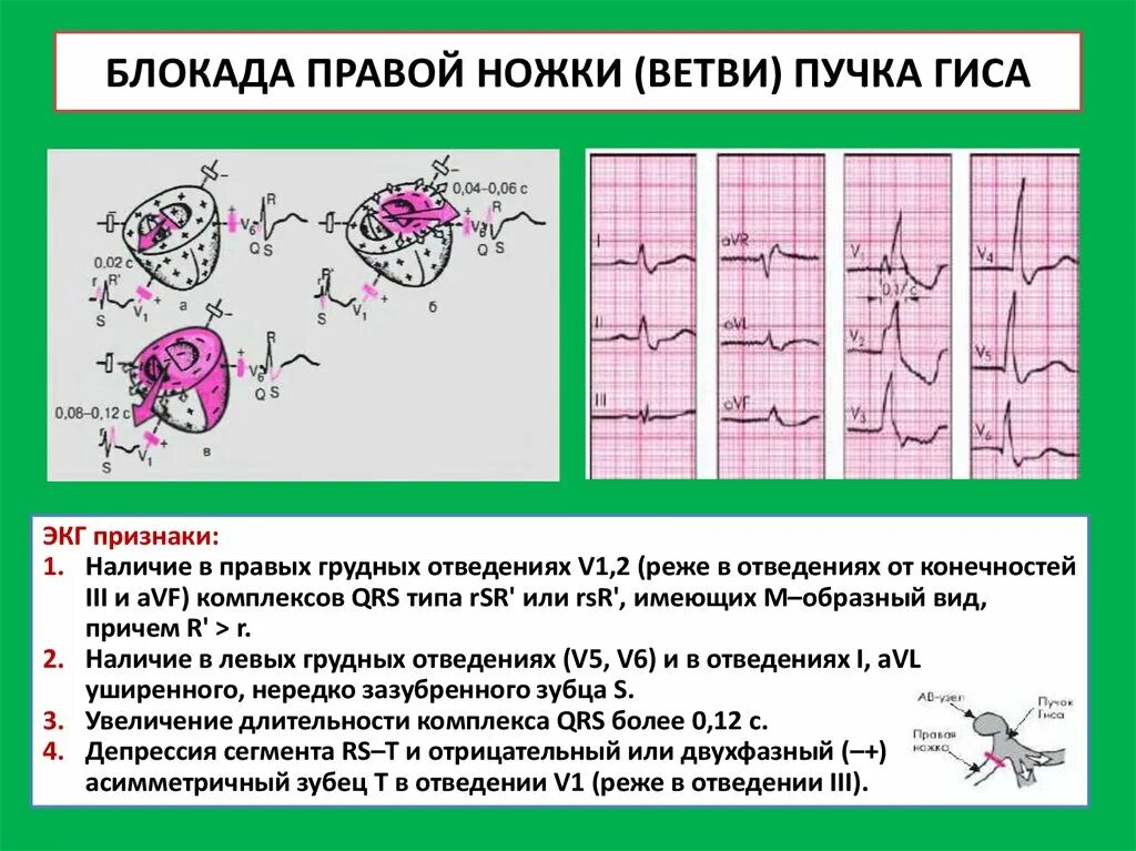 Блокада правой ножки желудочка. ЭКГ признаки полной блокады правой ножки п Гиса. Блокада правой ножки пучка Гиса на ЭКГ. Признаки блокады правой ножки пучка Гиса на ЭКГ. Полная и неполная блокада правой ножки пучка Гиса.