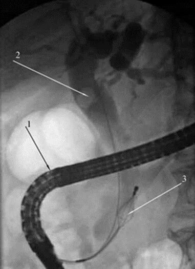 Ретроградная холангиопанкреатография (РХПГ). Острый холецистит ЭРХПГ. Стентирование желчного протока. Стентирование холедоха желчного протока. Стент желчного протока