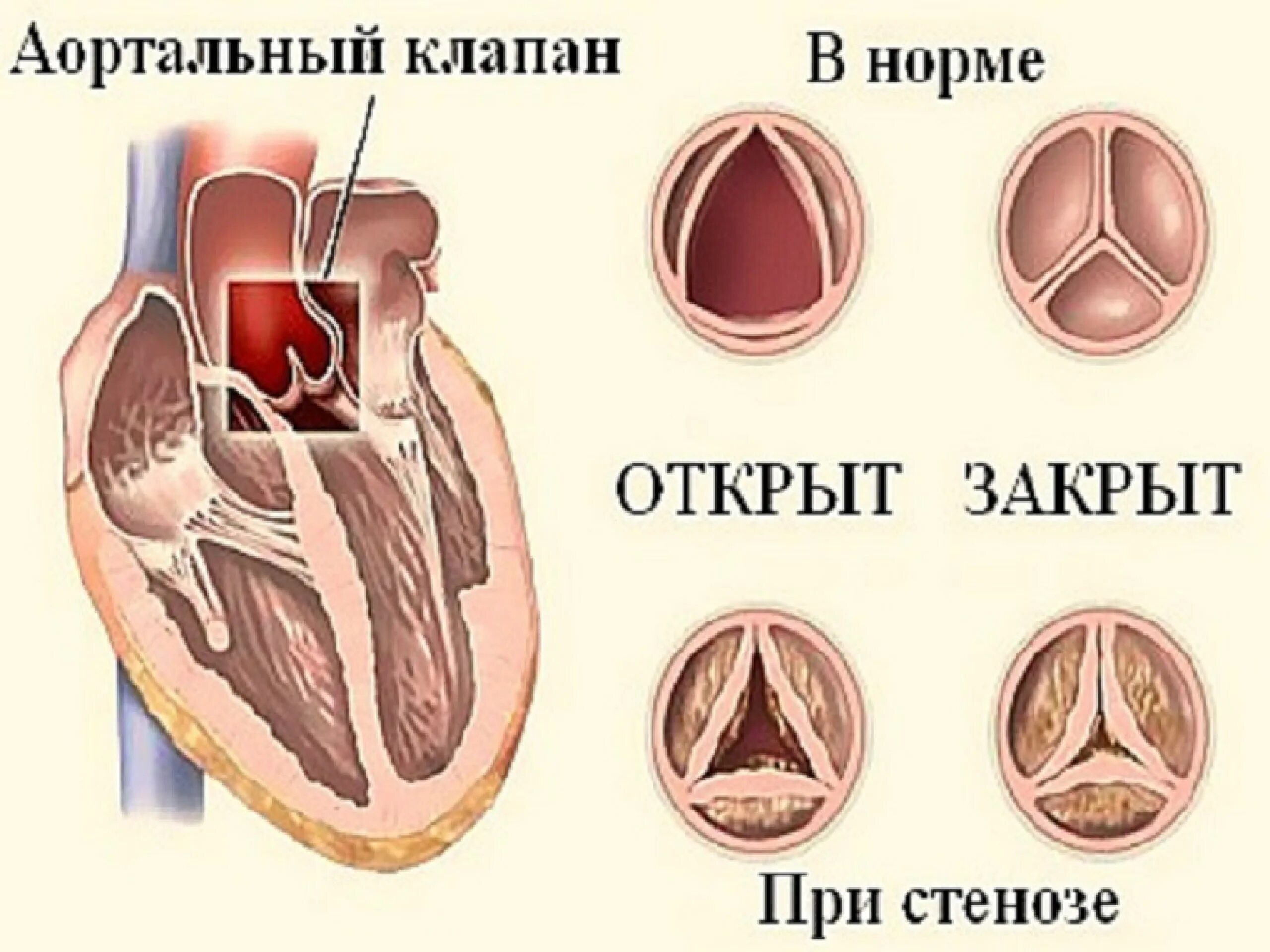 Кальциноз митрального клапана. Дегенеративный порок аортального клапана. Кальциноз створок аортального клапана. Аортальный клапан норма. Кальциноз створок митрального клапана.