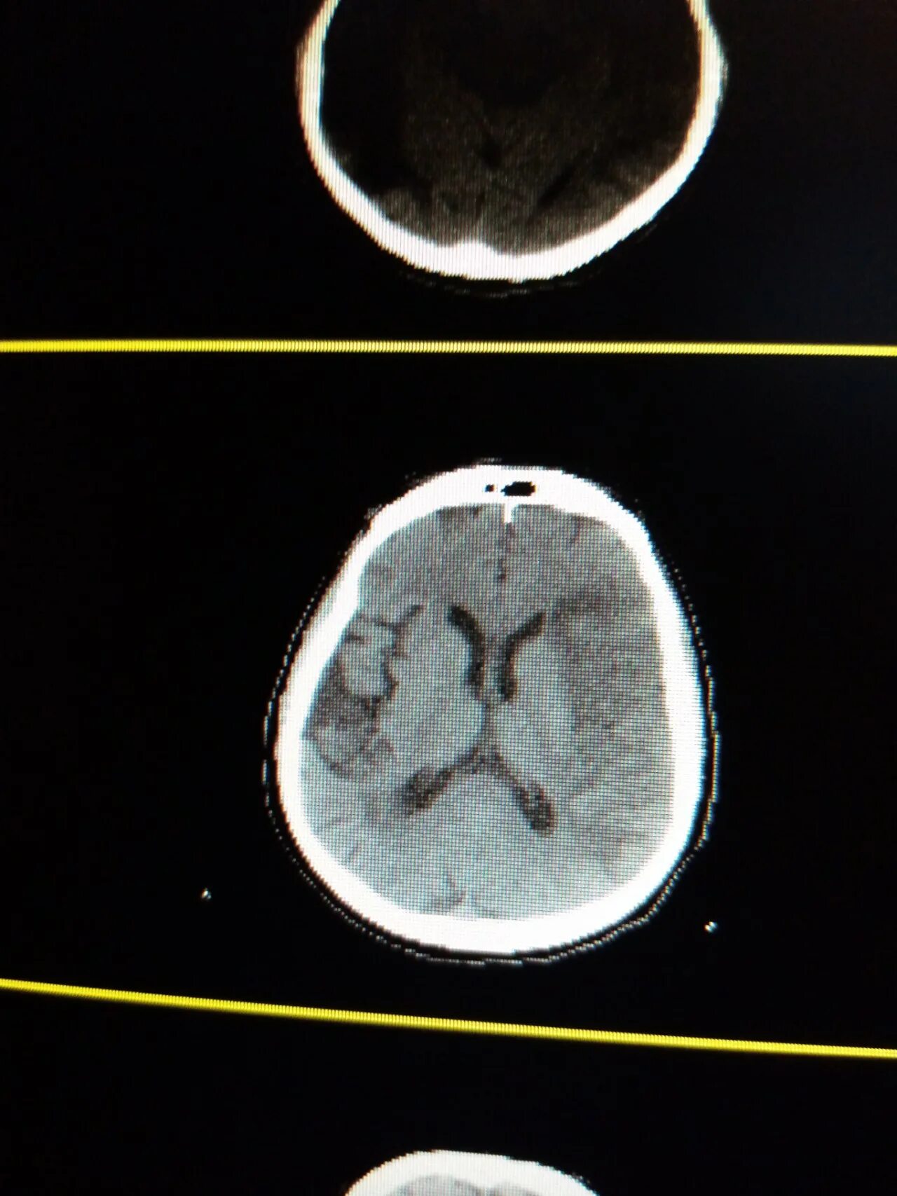 Третий инсульт шансы. Зачет по кт снимкам. Маленькие дырочки в голове на снимке кт.