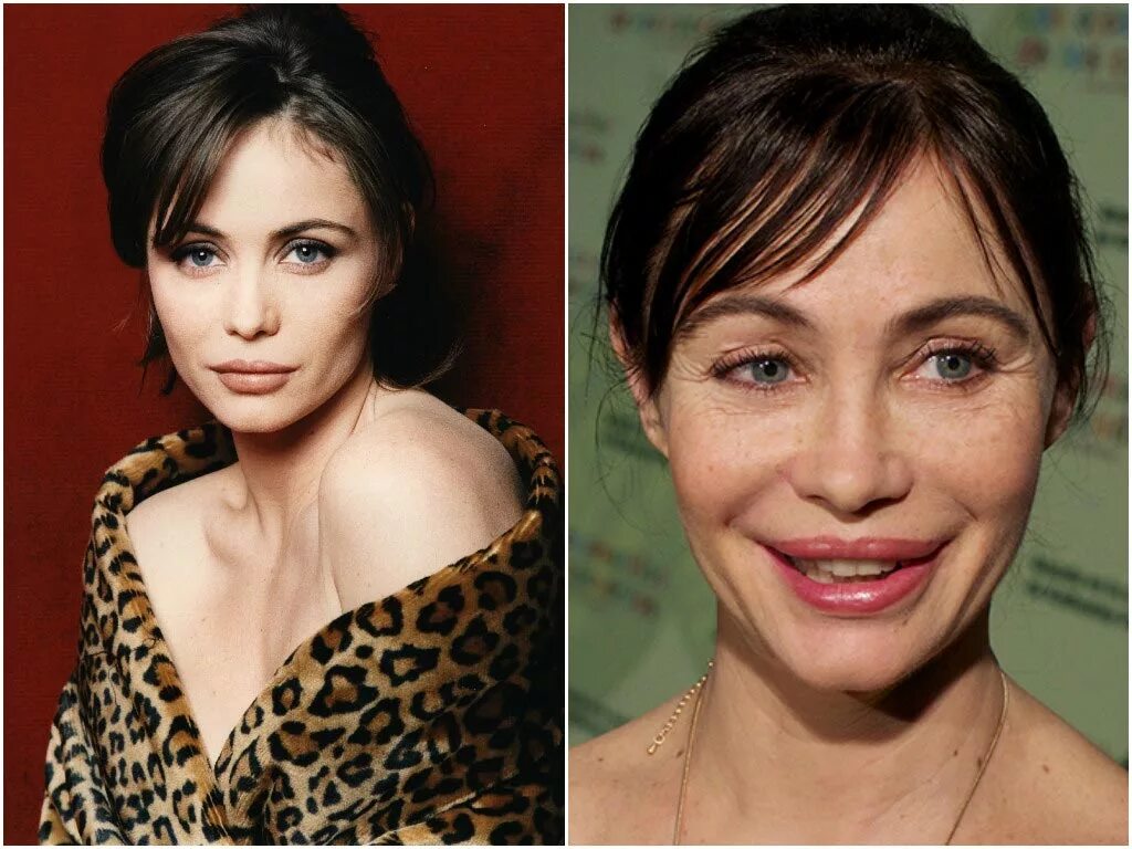 Сделала неудачную пластику