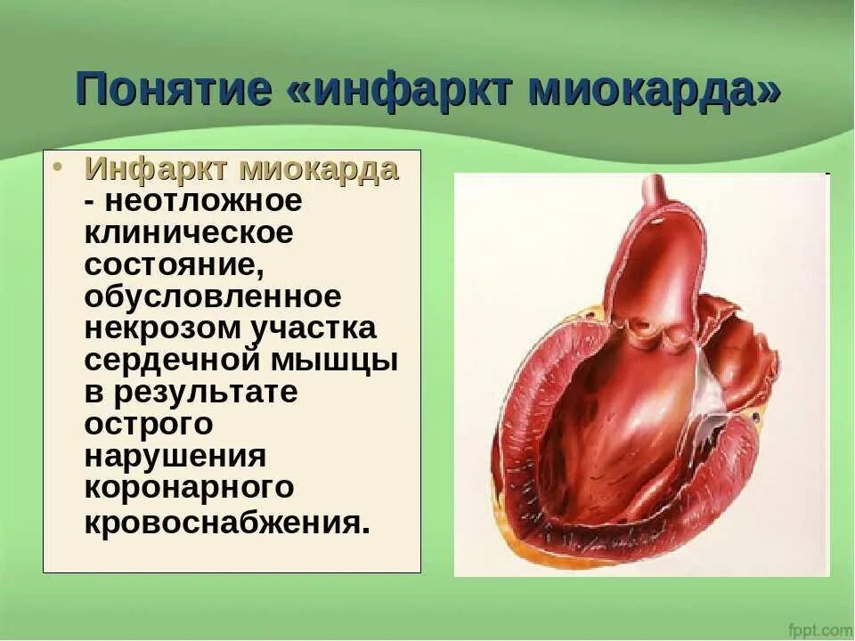 Инфаркт миокарда понятие. Презентация на тему инфаркт. Доклад на тему инфаркт.