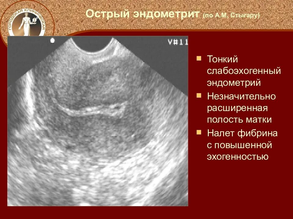 Смешанная эндометрия. Хронический эндометрит УЗИ. Признаки хронического эндометрита на УЗИ. Послеродовой эндометрит УЗИ. УЗИ при хроническом эндометрите.