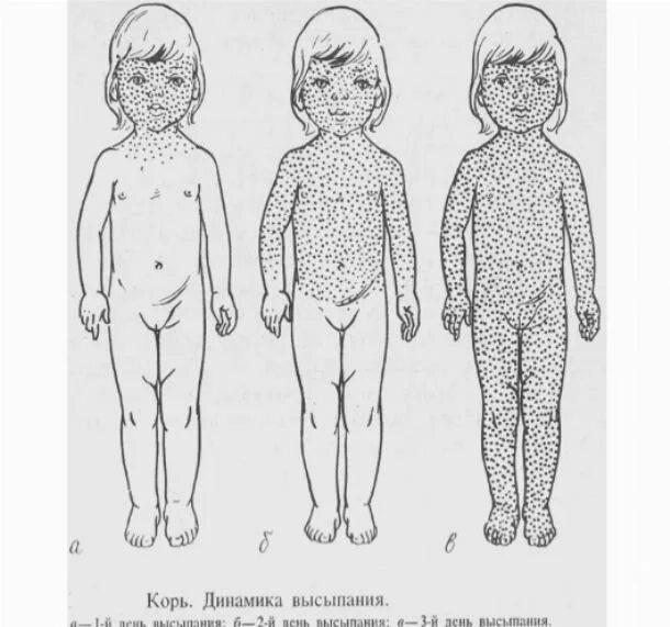 Сыпь отличия. Сыпь при корь краснуха. Корь краснуха скарлатина ветрянка. Ветрянка краснуха скарлатина. Высыпания корь краснуха ветрянка.