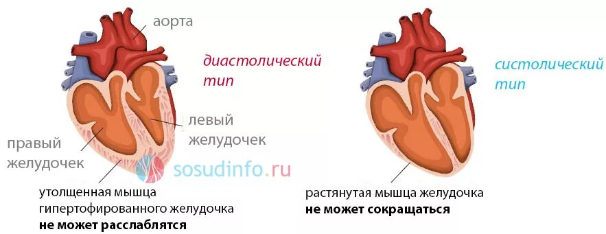 Дисфункции желудочков сердца. Нарушение систолической функции левого желудочка. Систолическая дисфункция левого желудочка 1. Бессимптомная систолическая дисфункция левого желудочка. Диастолическая функция левого желудочка сердца.