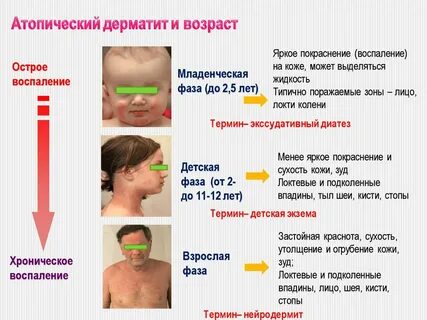 Атопический дерматит причины и лечение у взрослых