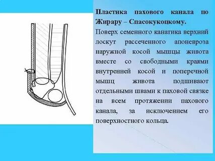 Операция пахового канала