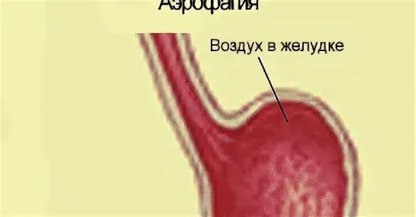 Воздух в желудке