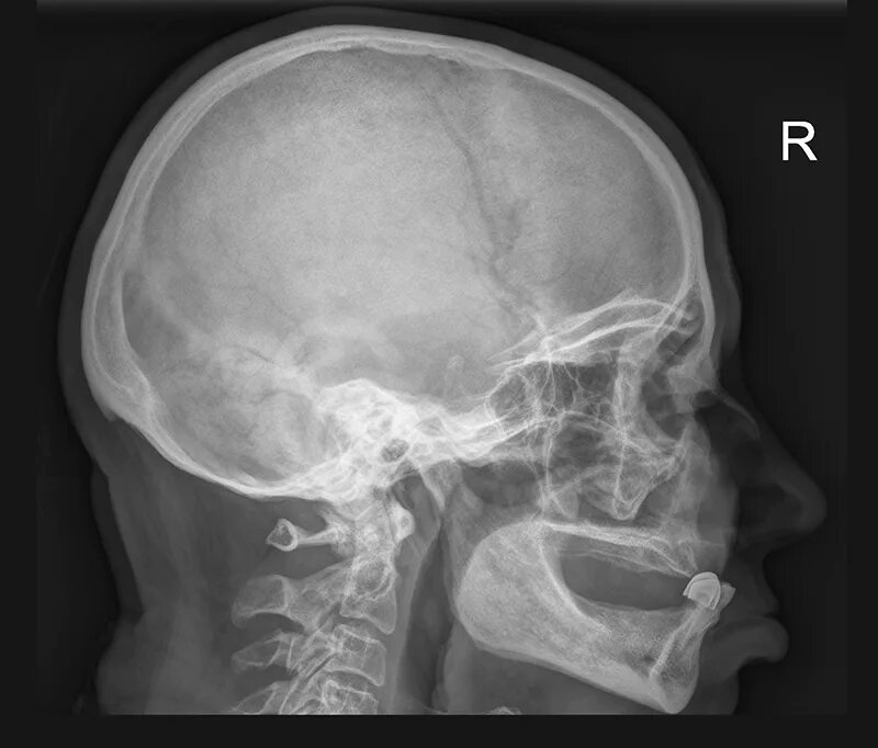 Трещина в голове. Перелом височной кости рентген. Перелом височной кости рентген снимки. Вдавленный перелом костей черепа рентген. Перелом височной кости на рентгенограмме черепа.
